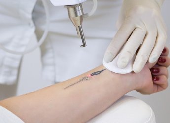 Laser Tattoo Removal – Safely Remove Unwanted Ink