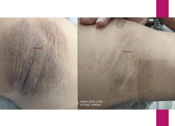 Dark Underarms Treatment – Restore Your Skin’s Confidence