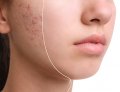 Acne Scar Treatment – Smooth & Clear Skin Restored