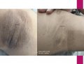 Dark Underarms Treatment – Restore Your Skin’s Confidence